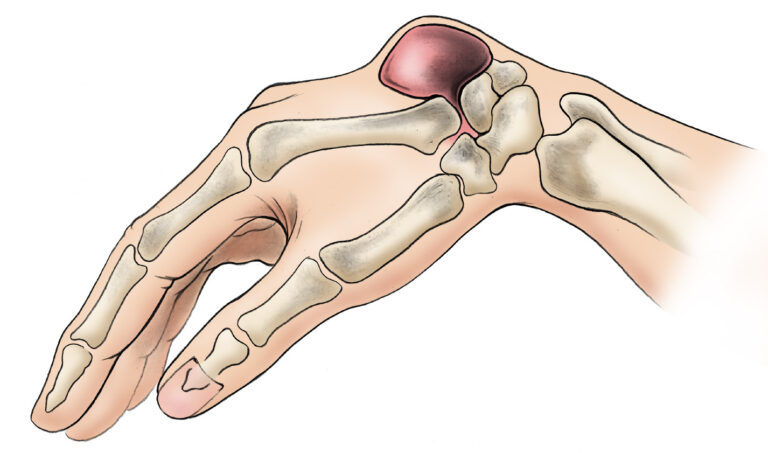 Discuss etiology of Ganglion Cyst and its possible relationship to Vitamin D and treatment options.