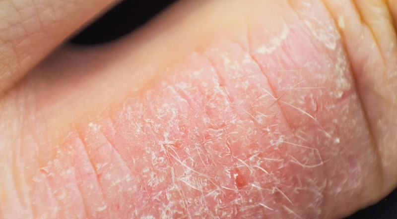 Skin rashes