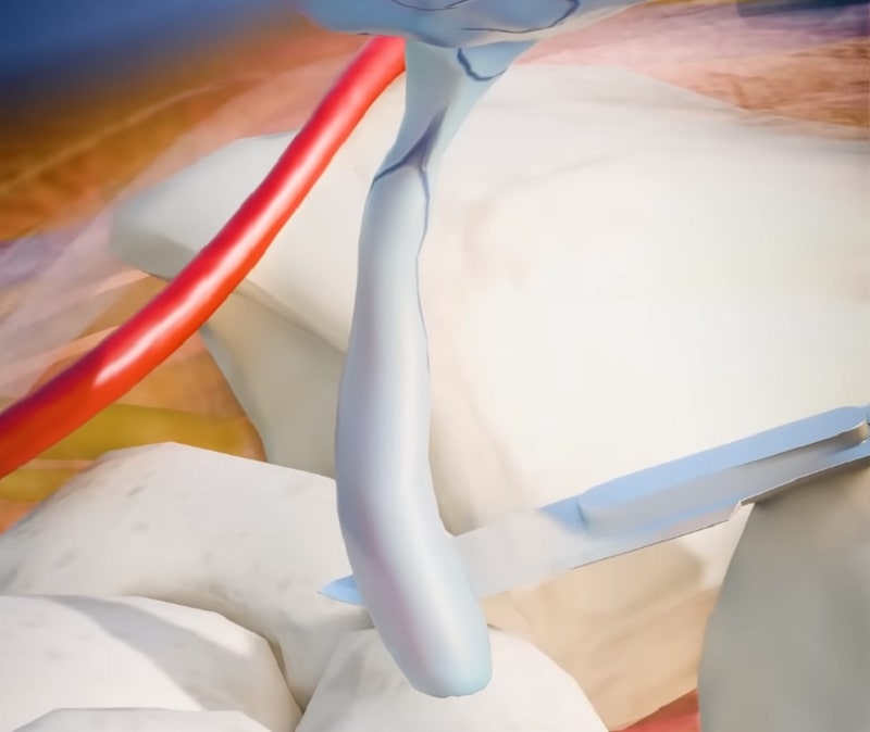 Treatment of Ganglion Cysts - Surgery