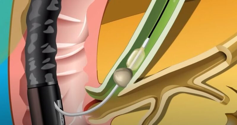 ERCP Procedure