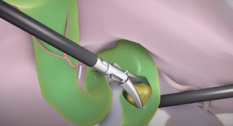 Laparascopic Bile Duct Exploration